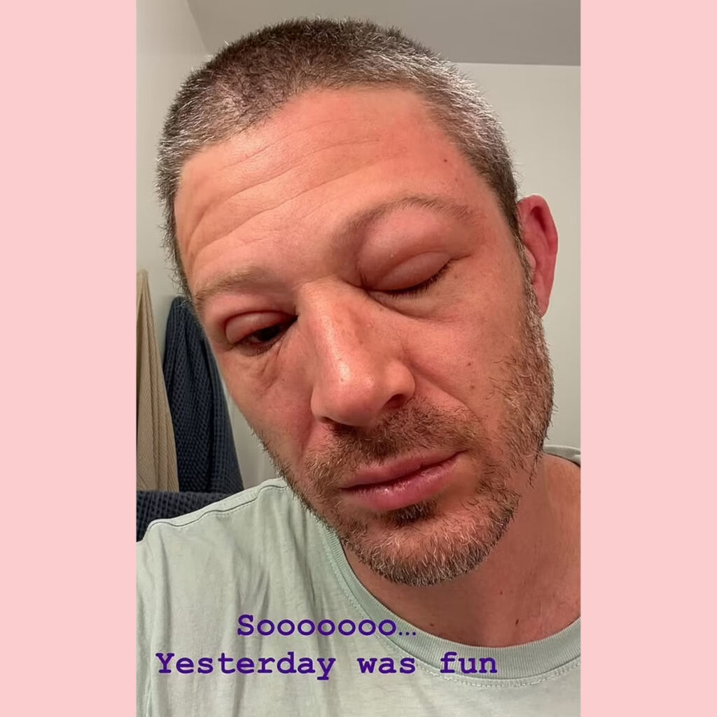 Friday Night Lights Star Zach Gilford Shares INSANE Photos Of Face After Health Scare!