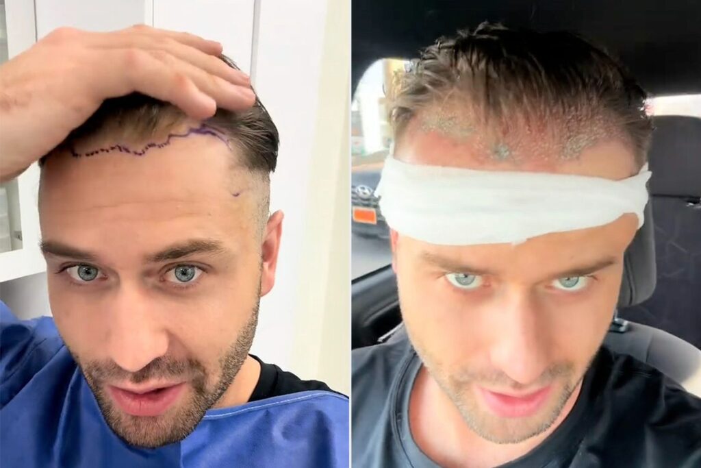 Mormon Wives Star Dakota Mortensen Details ‘Bloody’ Hair Transplant Journey