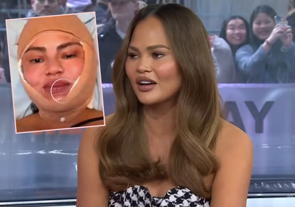 Chrissy Teigen Speaks Out After Concerning IG Live Of Herself With A Bandaged Face! 